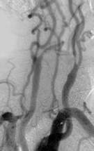 Angiographie numrise des vaisseaux du cou, stnose significative de la cartide interne gauche