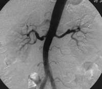 Angiographie de l'aorte et des artres rnales, stnose de l'artre rnale droite